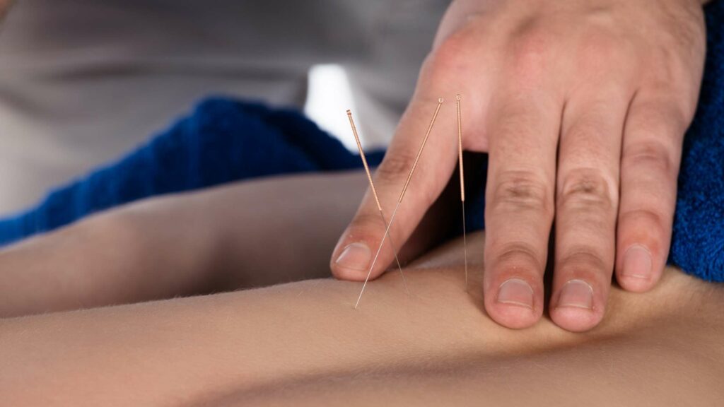 Acupuncture, An Integrative Therapy